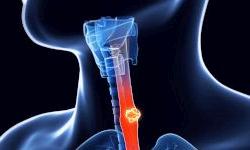 Выдыхаемый воздух поможет в диагностике