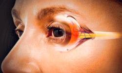 Новая методика в лечении глаукомы